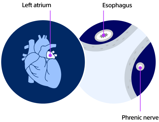 How  cardiac ablation works