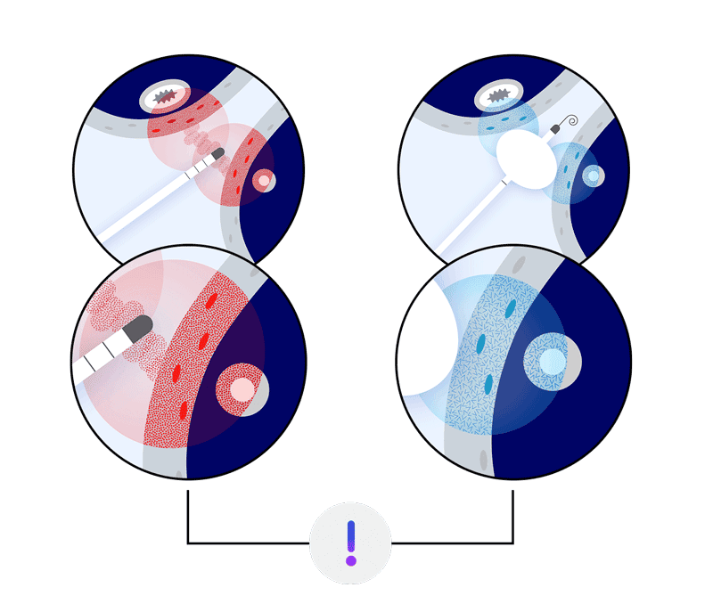 Illustration of traditional cardiac ablation showing how hot or cold thermal energy can cause collateral damage to nearby tissues such as the esophagus or phrenic nerve.