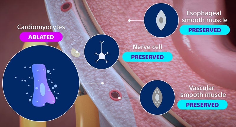 Diagram showing how pulsed field ablation selectively ablates cardiomyocytes while preserving nearby esophageal smooth muscle, nerve cells, and vascular smooth muscle.
