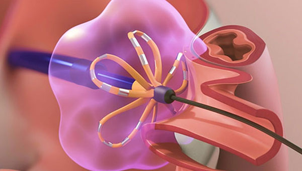 Image of FARAPULSE device inside heart.
