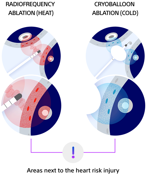 Traditional cardiac ablation